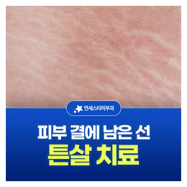 튼살 치료, 피부 곁에 남은 선 어떤 부위라도 효과적인 치료