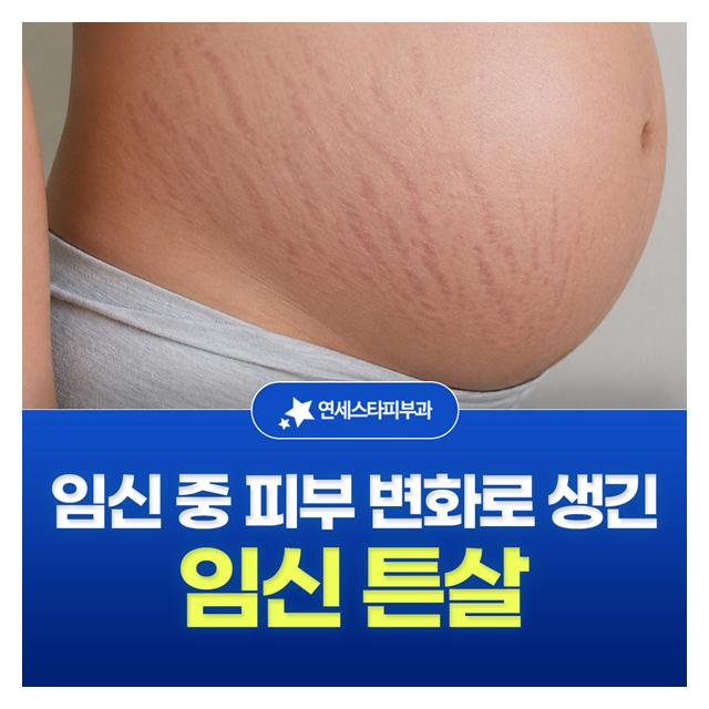임신 튼살, 임신 중 피부 변화로 생긴 튼살도 치료 가능합니다