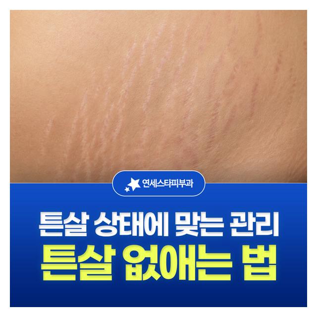 튼살 없애는 법, 튼살 상태에 맞는 관리를 통해 높은 호전도를 약속합니다