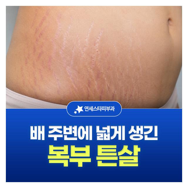 복부 튼살, 배 주변에 넓게 생긴 튼살도 연세스타피부과에서 해결하세요